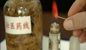 【明秀分院特色疗法】壮医药线点灸疗法