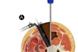 侧路腰椎椎体间融合术 Lateral Lumbar Interbody Fusion (LLIF) 　 