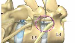 椎间孔镜技术 椎间孔镜下腰椎间盘突出症髓核摘除术（PELD）