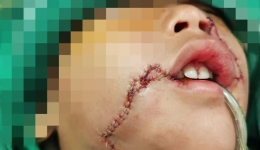 2岁男童被家犬疯狂撕咬，面部多处撕裂伤，缝了300多针