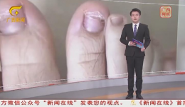 【广西新闻】长期未卸美甲 女子长出灰指甲