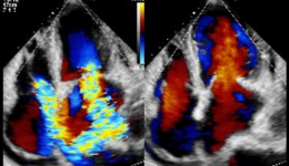 59岁尿毒症患者因何遭到心脏病连环攻击？