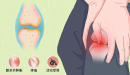 膝盖能“预测天气”？警惕膝关节骨性关节病的四级信号