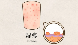 春季湿疹高发，专家提醒：治疗湿疹不能单靠“祛湿”