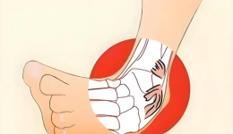 问诊贴士｜夏季运动损伤如何科学处理？