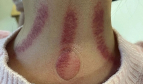 孩子感冒不想吃药？试试儿科急诊中医民族医特色外治法